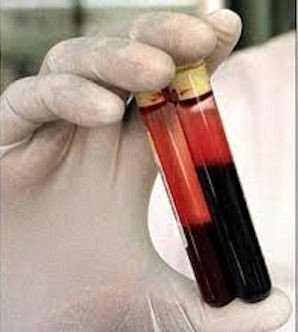 Hepatits test results in South Sudan unreliable